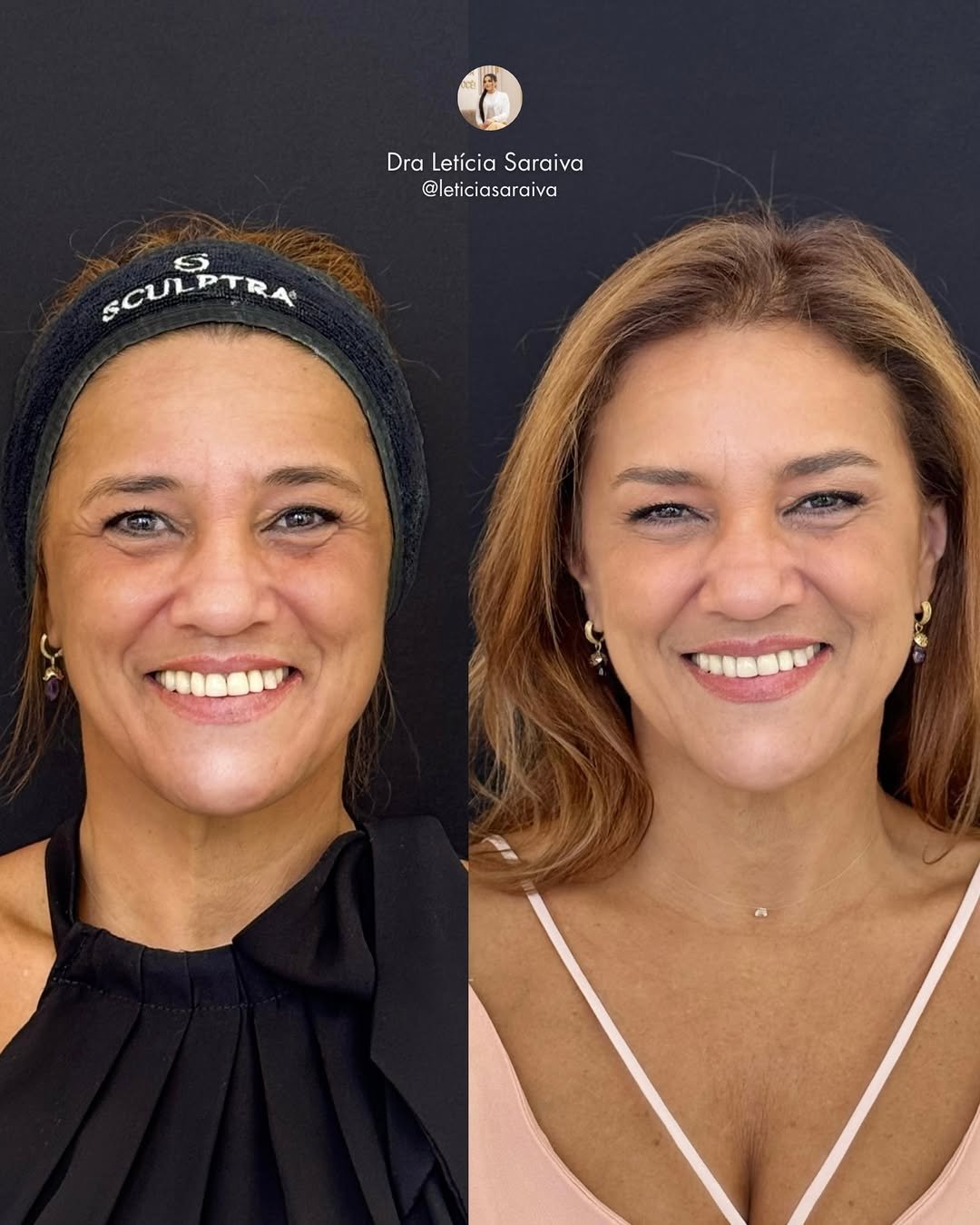 Botox antes e depois - Rejuvenescimento Natural em Fortaleza