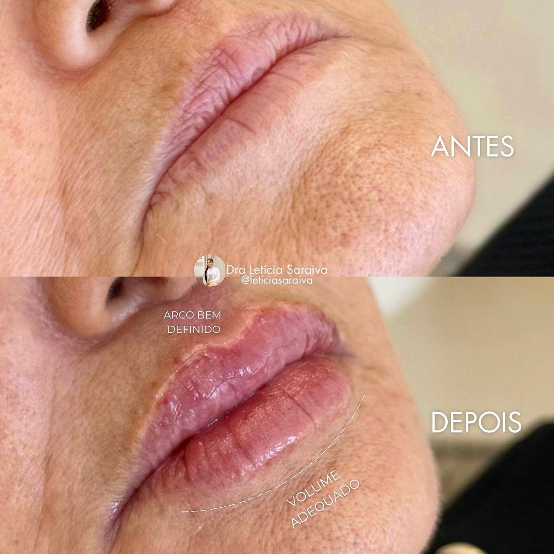 Preenchimento Labial antes e depois - Resultados Naturais em Fortaleza