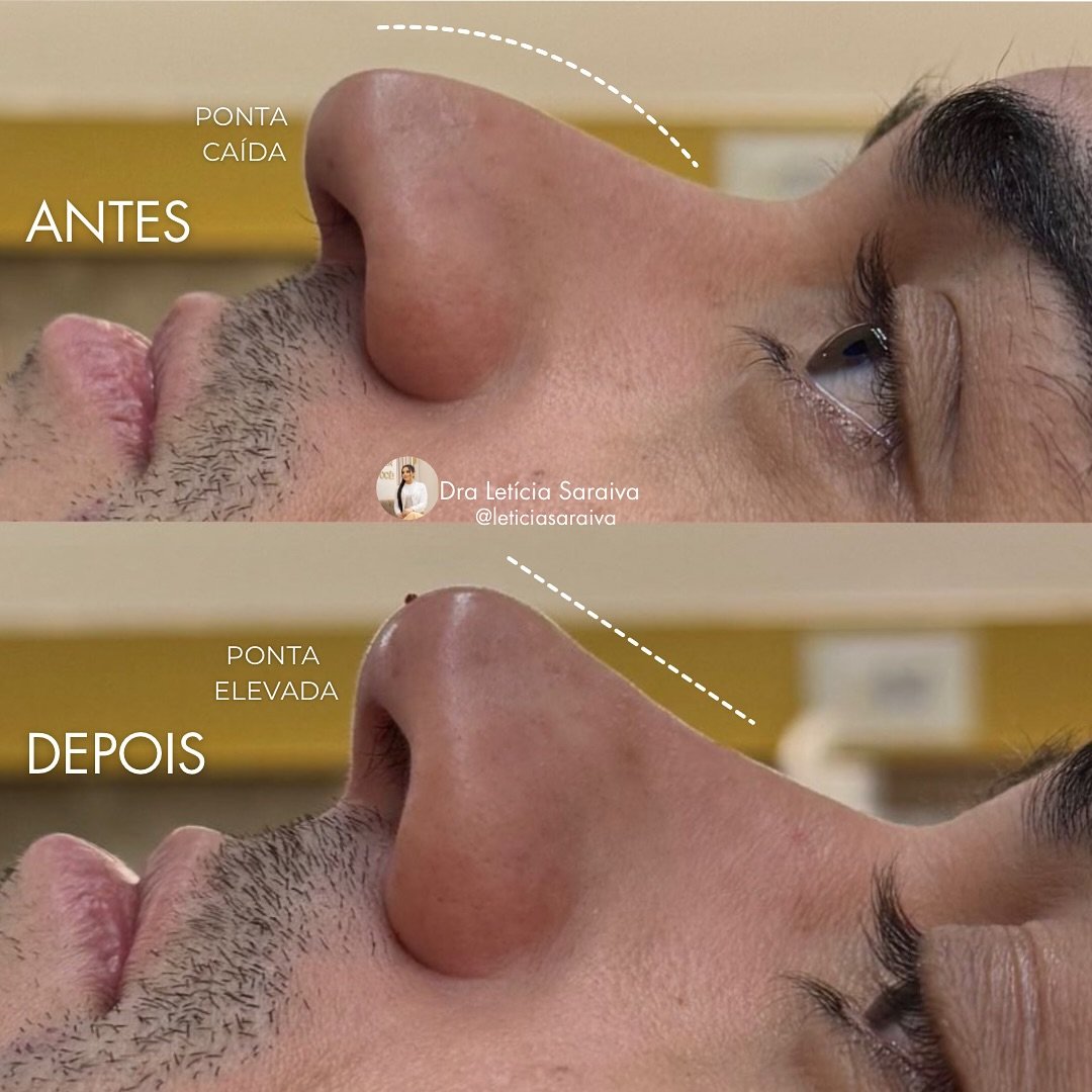 Rinomodelação antes e depois - Harmonização Facial Natural em Fortaleza